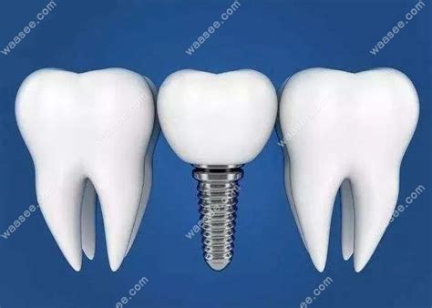 种植牙-种植体：四级钛、五级钛、钛合金有什么区别？ - 知乎