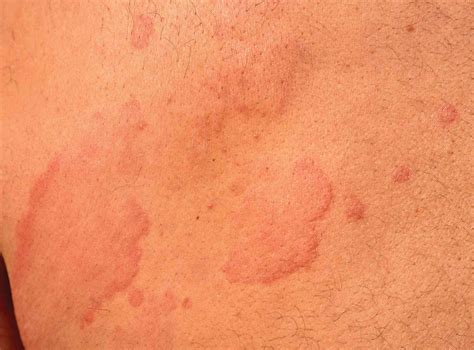 Cold Rash (Cold Urticaria): Overview and More