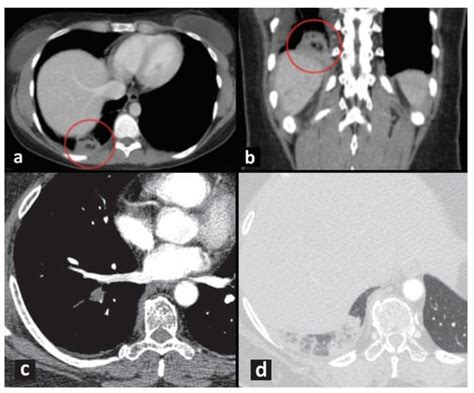 Pulmonary Embolism Presenting with Pulmonary Infarction: Update and ...