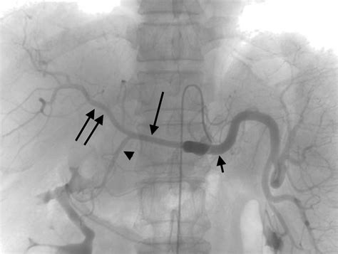 Mesenteric ischemia | Radiology Key