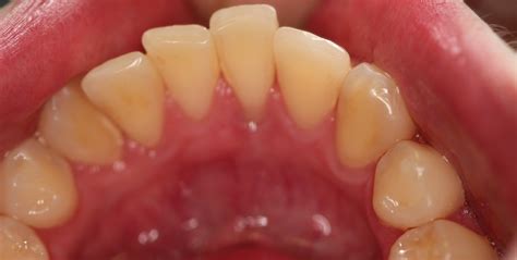 Gum Erosion Tongue Rings What Causes Gum Recession?