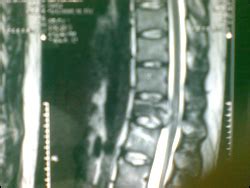 Dr. Partha Pratim Bishnu - Spine Doctor in Kolkata, Ant Thoracic Spinal ...