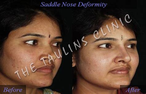 Polly Beak Deformity Bangalore, INDIA:::