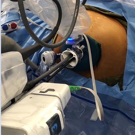 Image result for Robotic Retroperitoneal Partial Nephrectomy