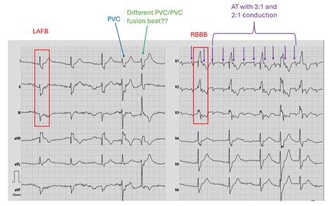 Left anterior fascicular block | ECG Guru - Instructor Resources