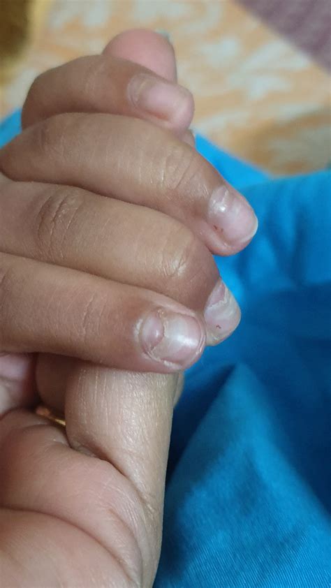 Peeling Nails? Nails Falling Off? Onychomadesis after Hand, Foot, and ...