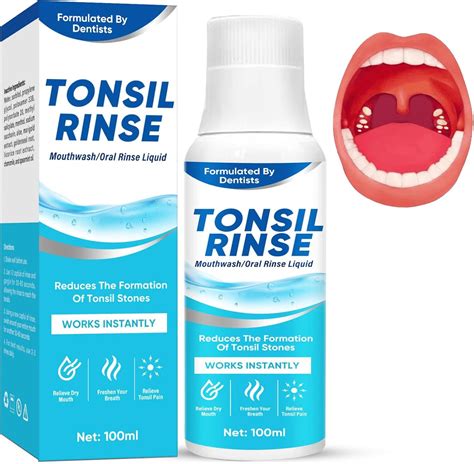 Home Cure For Tonsil Stones