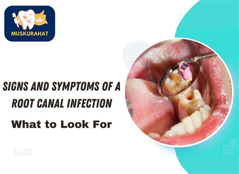 Signs and Symptoms of a Root Canal Infection: What to Look For