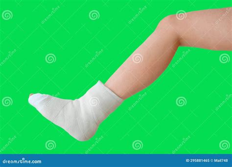 Broken Leg on a Green Background in a Plaster Cast. Foot Bone Bruise or ...