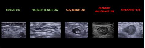 Ultrasound Evaluation of Inguinal and Pelvic Lymph Nodes | Article | GLOWM