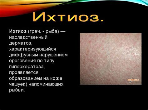 Ихтиоз арлекина: фото, лечение, причины, симптомы и профилактика