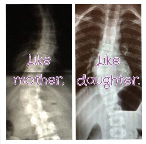 Is Scoliosis Hereditary Disease - mapametawan