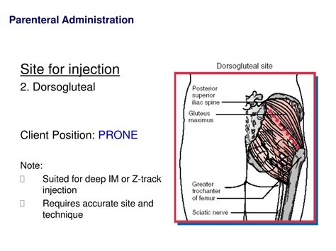Dorsogluteal Injections: A Comprehensive Guide to Risks, Benefits, and ...