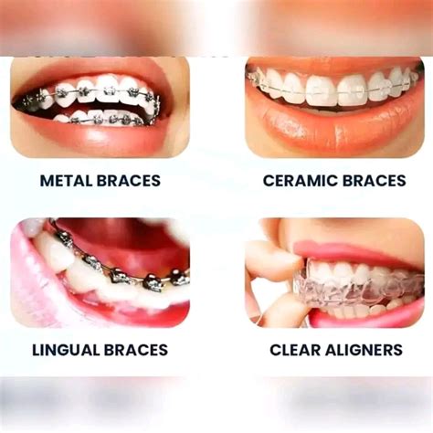 Types of Braces in Kampala - Dental Clinic in Kampala