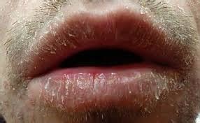 Oral Manifestations Of Dengue Fever