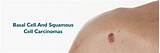 Basal Cell and Squamous Cell Carcinomas