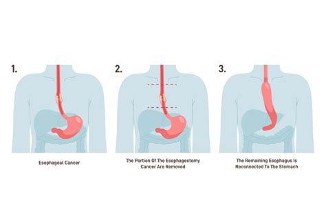 Esophagectomy - O2 Healthcare Group