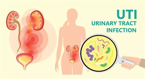 UTI Symptoms, Causes, and Treatment: A Complete Guide | Aster