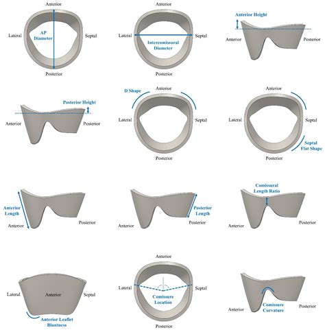 Leaflet Lengths and Commissural Dimensions as the Primary Determinants ...