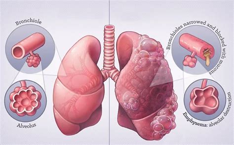 Dr. Neel Mehta | Chest Physician In Kurla
