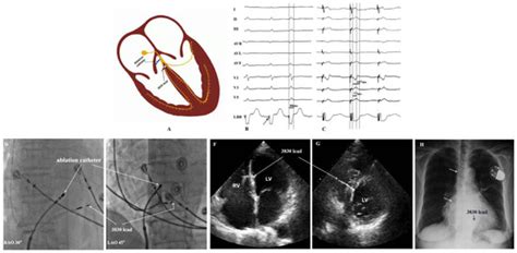 Atrial Fibrillation: State-of-the-Art Techniques and Future ...
