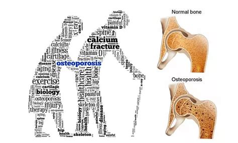 Zoledronic acid therapy for osteoporosis may raise risk of incident AF ...