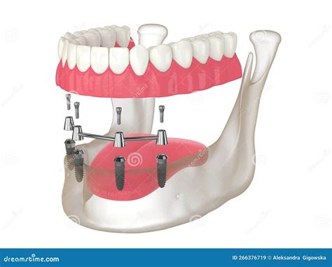 Bar Retained Implant Overdenture at Jason Gibbons blog