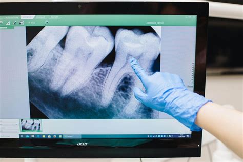3 Common Dental X-Ray Errors (And How Tarsier X Helps You Avoid Them) | Eikona X