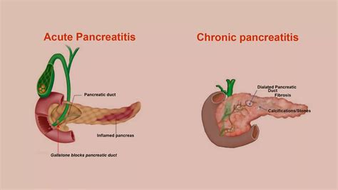 Why Does Acute Pancreatitis Cause Hypotension - Cardiovasculardiseasehub.com - why is pancreatitis dangerous