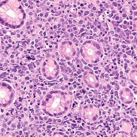 Mosunetuzumab + Polatuzumab vedotin als Option ab 2L - Hämatologie ...