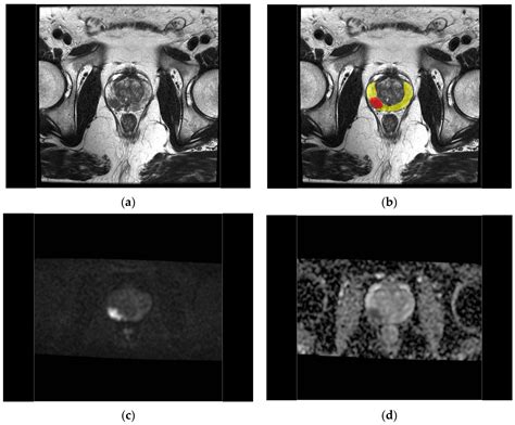 Comparison of Early Contrast Enhancement Models in Ultrafast Dynamic ...