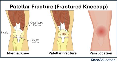 Patellar Fracture - Knee Education