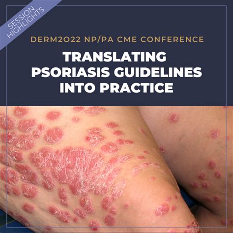 Clinical Practice Guideline For Psoriasis – FDXE