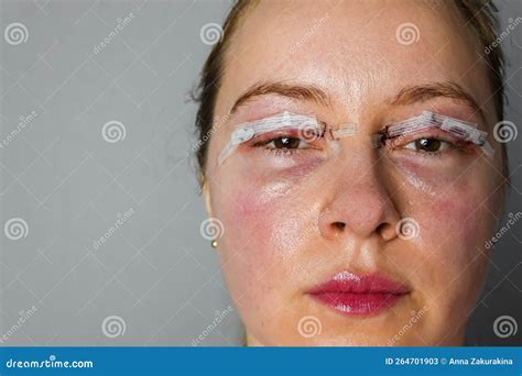 Woman Face After Plastic Surgery, Blepharoplasty Operation, Swelling Eye Bags, Incisions With ...