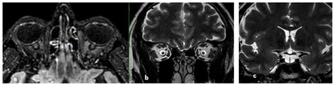 Imaging of Cerebral Venous Thrombosis