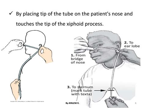 NASOGASTRIC TUBE INSERTION.pdf