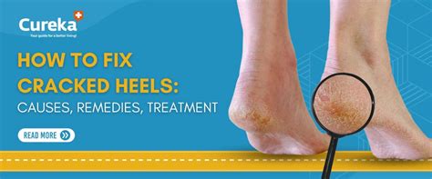 How To Fix Cracked Heels: Causes, Remedies, Treatment