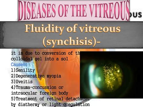 PPT - Vitreous Anatomy & Diseases: Understanding Symptoms, Causes, and Treatment Options ...