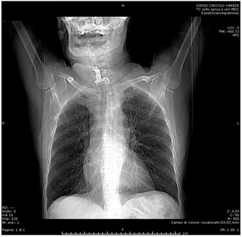 Dental Prosthesis in Esophagus: A Right Cervicotomic Approach