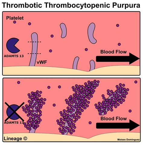 Idiopathic Thrombocytopenic Purpura Diagram