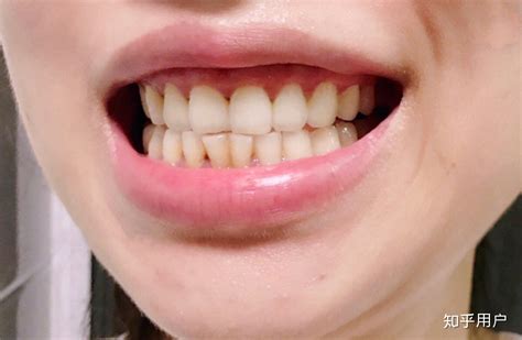 牙齿美白对牙齿有伤害吗？ - 知乎