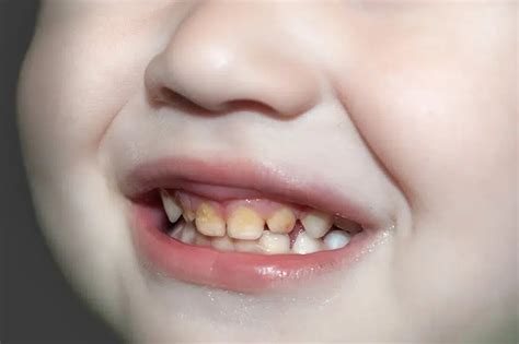 Image result for Calcium Buildup Front Teeth