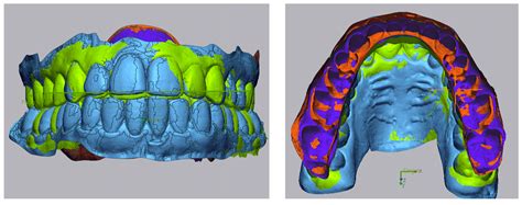 Distalization with Clear Aligners: Accuracy, Impact of Mini-Screws, and ...