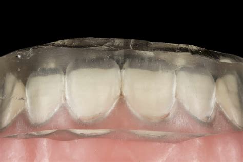 6-step guide to injection moulding for dentists | Avant Dental