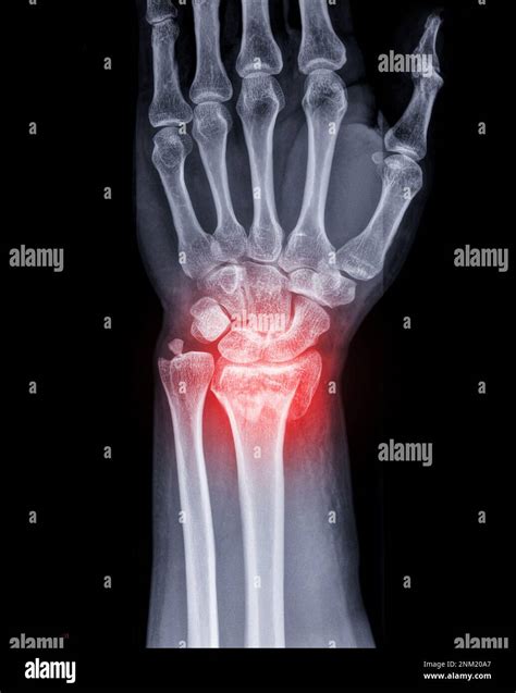 X-ray image of Left wrist joint AP and Lateral view for showing ...