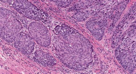 Esophageal Squamous Cell Carcinoma Histology
