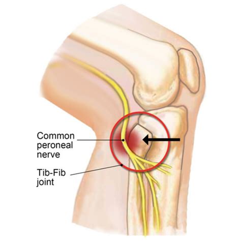 Tib And Fib