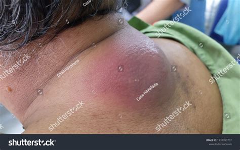 Infected Abscess Lanced 的图像结果