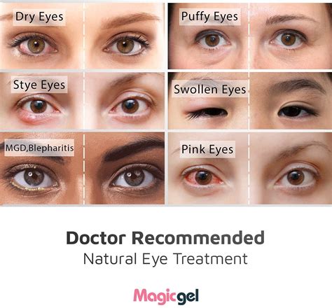 Eye Swelling Treatment Tablets at Bobby Haley blog