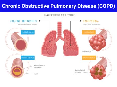 Chronic Obstructive Pulmonary Disease Copd
